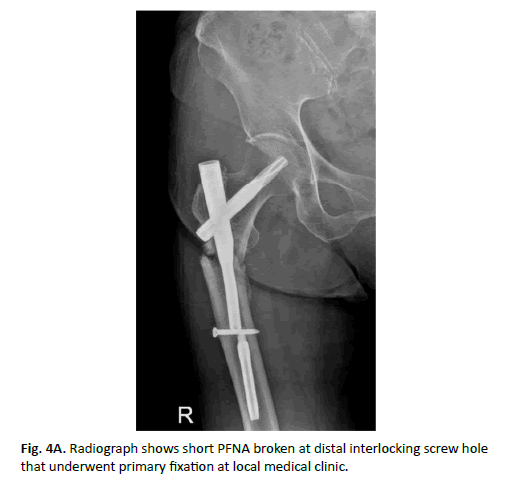 Treatment of the failed intramedullary fixation using long cephalomedullary  nail for atypical subtrochanteric femoral fractures