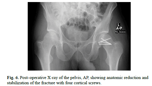 Orthopaedics-Trauma-Surgery-Related-Research-anatomic-reduction