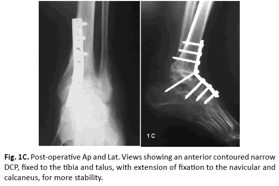 Orthopaedics-Trauma-Surgery-Related-Research-anterior-contoured