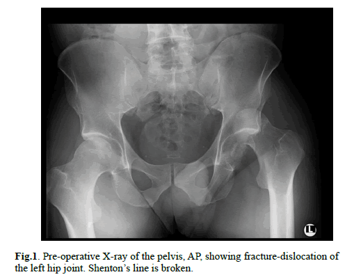 Orthopaedics-Trauma-Surgery-Related-Research-fracture-dislocation