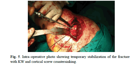 Orthopaedics-Trauma-Surgery-Related-Research-temporary-stabilization