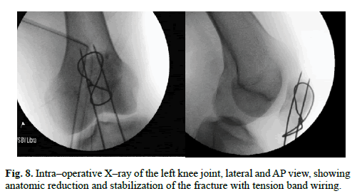 Orthopaedics-Trauma-Surgery-Related-Research-tension-band