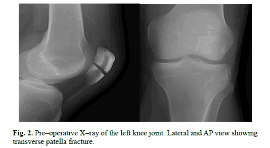 Orthopaedics-Trauma-Surgery-Related-Research-transverse-patella