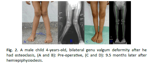 Orthopaedics-Trauma-Surgery-Related-Research-valgum-deformity