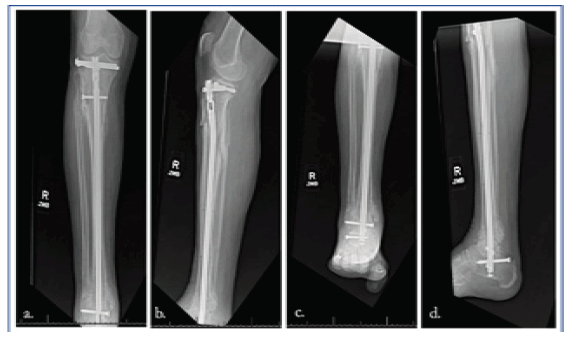 Primary Tibiotalocalcaneal Fusion for High-risk Complex Ankle Fractures