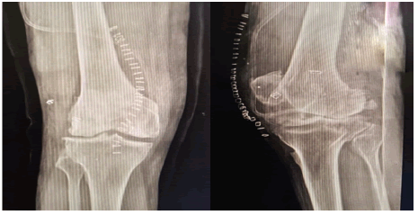 jotsrr-X-ray