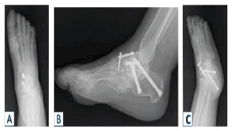 jotsrr-arthrodesis