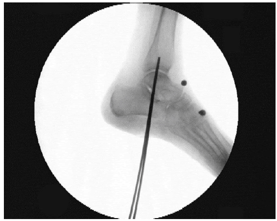 Tibial Shaft Fractures | Musculoskeletal Key