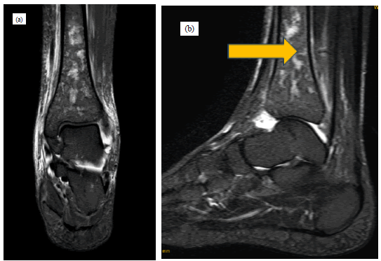 jotsrr-investigation-epimetaphyseal