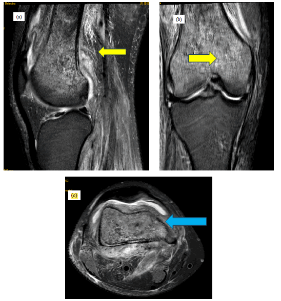 jotsrr-investigation-femur