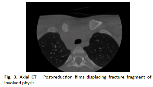 Orthopaedics-Trauma-Surgery-Axial-CT-Post-reduction