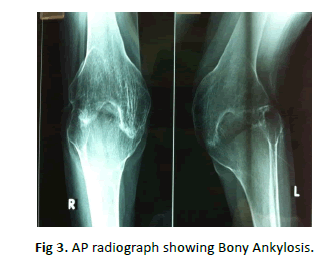 Orthopaedics-Trauma-Surgery-Bony-Ankylosis