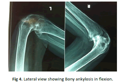Orthopaedics-Trauma-Surgery-Bony-ankylosis-flexion