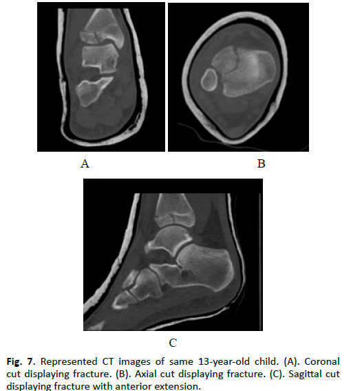 Orthopaedics-Trauma-Surgery-Coronal-displaying-fracture