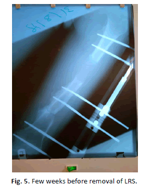 Orthopaedics-Trauma-Surgery-Few-weeks-removal-LRS