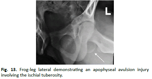 Orthopaedics-Trauma-Surgery-Frog-leg-lateral-demonstrating