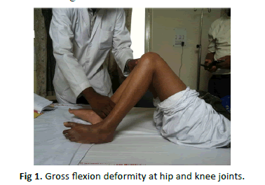 Orthopaedics-Trauma-Surgery-Gross-flexion-deformity-hip