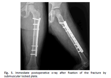 Orthopaedics-Trauma-Surgery-Immediate-postoperative-x-ray