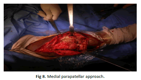 Orthopaedics-Trauma-Surgery-Medial-parapatellar