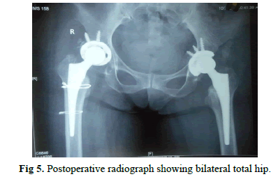 Orthopaedics-Trauma-Surgery-Postoperative-radiograph-bilateral-total-hip