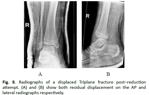 Orthopaedics-Trauma-Surgery-Radiographs-displaced-Triplane