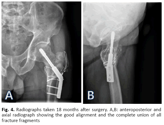 Orthopaedics-Trauma-Surgery-Related-Research-Anteroposterior-axial