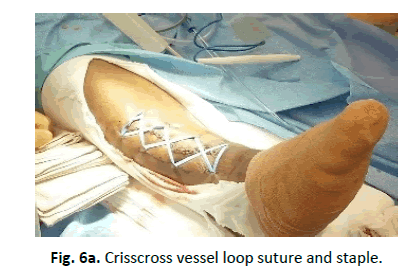 Orthopaedics-Trauma-Surgery-Related-Research-Crisscross-vessel-loop