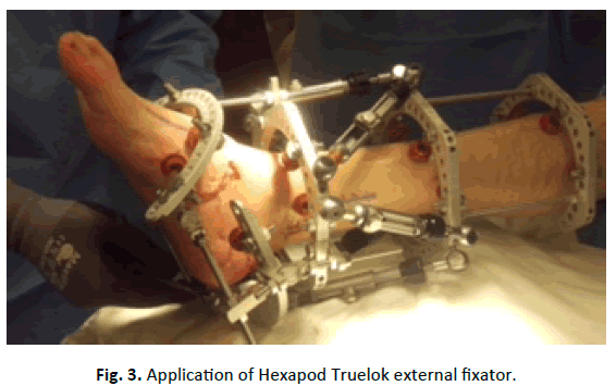 Orthopaedics-Trauma-Surgery-Related-Research-Hexapod-Truelok