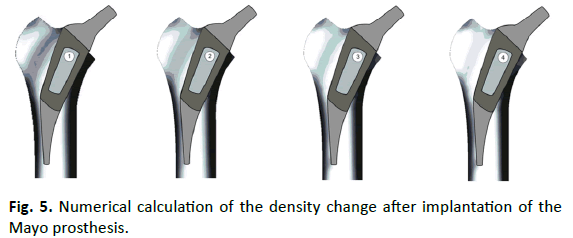 Orthopaedics-Trauma-Surgery-Related-Research-Mayo-prosthesis