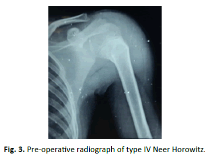 Orthopaedics-Trauma-Surgery-Related-Research-Neer-Horowitz