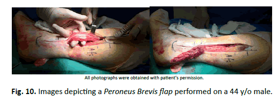 Orthopaedics-Trauma-Surgery-Related-Research-Peroneus-Brevis-flap