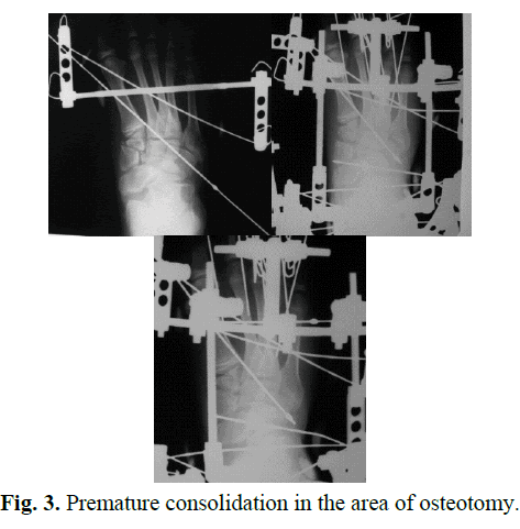 Orthopaedics-Trauma-Surgery-Related-Research-Premature