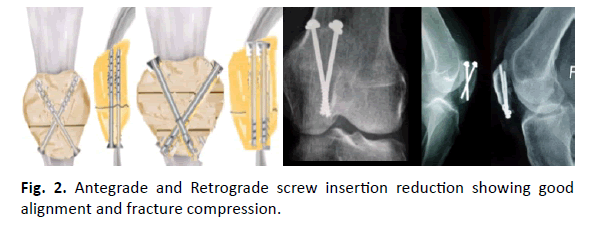 Orthopaedics-Trauma-Surgery-Related-Research-Retrograde-screw