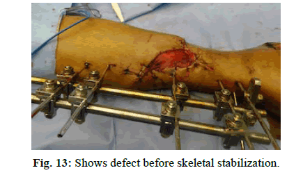 Orthopaedics-Trauma-Surgery-Related-Research-Shows-defect-before