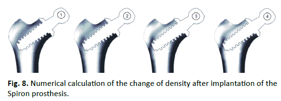 Orthopaedics-Trauma-Surgery-Related-Research-Spiron-prosthesis