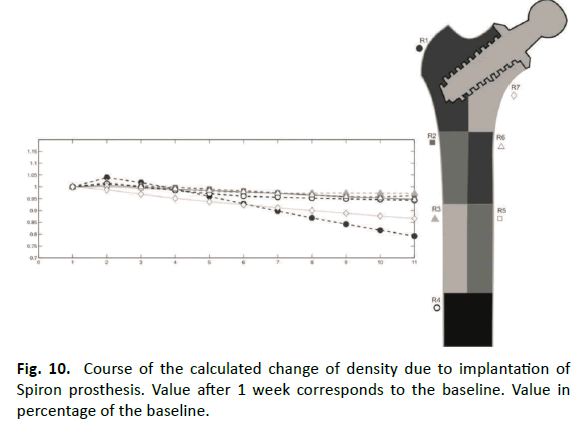 Orthopaedics-Trauma-Surgery-Related-Research-Spiron-prosthesis