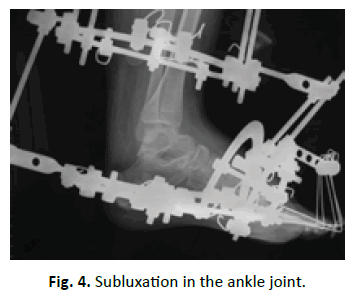 Orthopaedics-Trauma-Surgery-Related-Research-Subluxation
