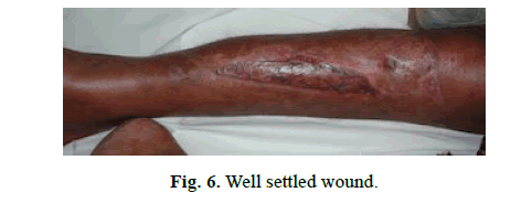 Orthopaedics-Trauma-Surgery-Related-Research-Well-settled-wound