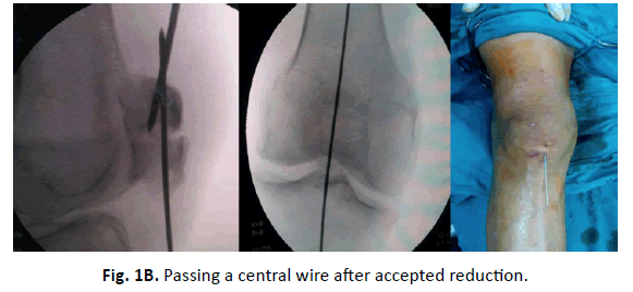 Orthopaedics-Trauma-Surgery-Related-Research-accepted-reduction