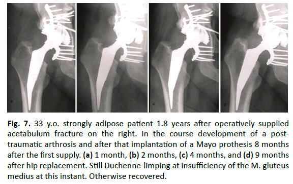 Orthopaedics-Trauma-Surgery-Related-Research-acetabulum-fracture