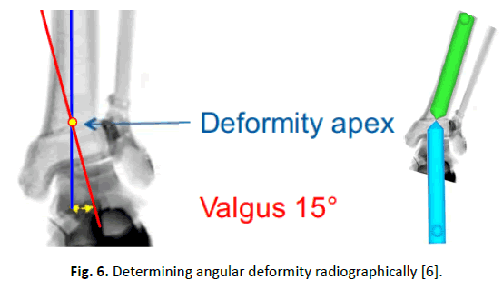 Orthopaedics-Trauma-Surgery-Related-Research-angular-deformity