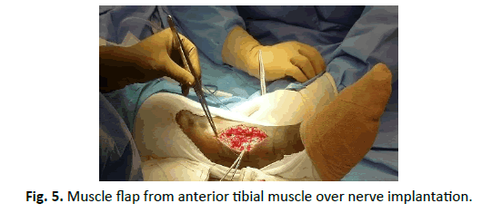 Orthopaedics-Trauma-Surgery-Related-Research-anterior-tibial-muscle