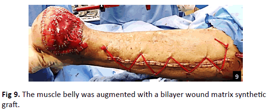 Orthopaedics-Trauma-Surgery-Related-Research-bilayer-wound