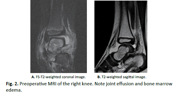 Orthopaedics-Trauma-Surgery-Related-Research-bone-marrow-edema