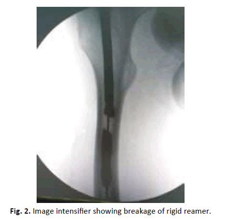 Orthopaedics-Trauma-Surgery-Related-Research-breakage-rigid