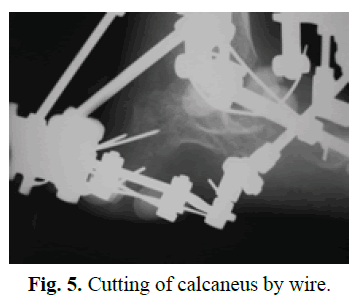 Orthopaedics-Trauma-Surgery-Related-Research-calcaneus