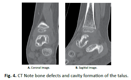 Orthopaedics-Trauma-Surgery-Related-Research-cavity-formation