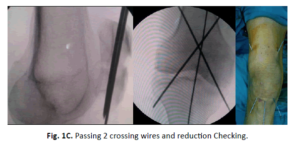 Orthopaedics-Trauma-Surgery-Related-Research-crossing-wires