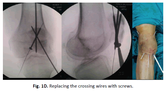 Orthopaedics-Trauma-Surgery-Related-Research-crossing-wires