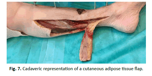 Orthopaedics-Trauma-Surgery-Related-Research-cutaneous-adipose-tissue